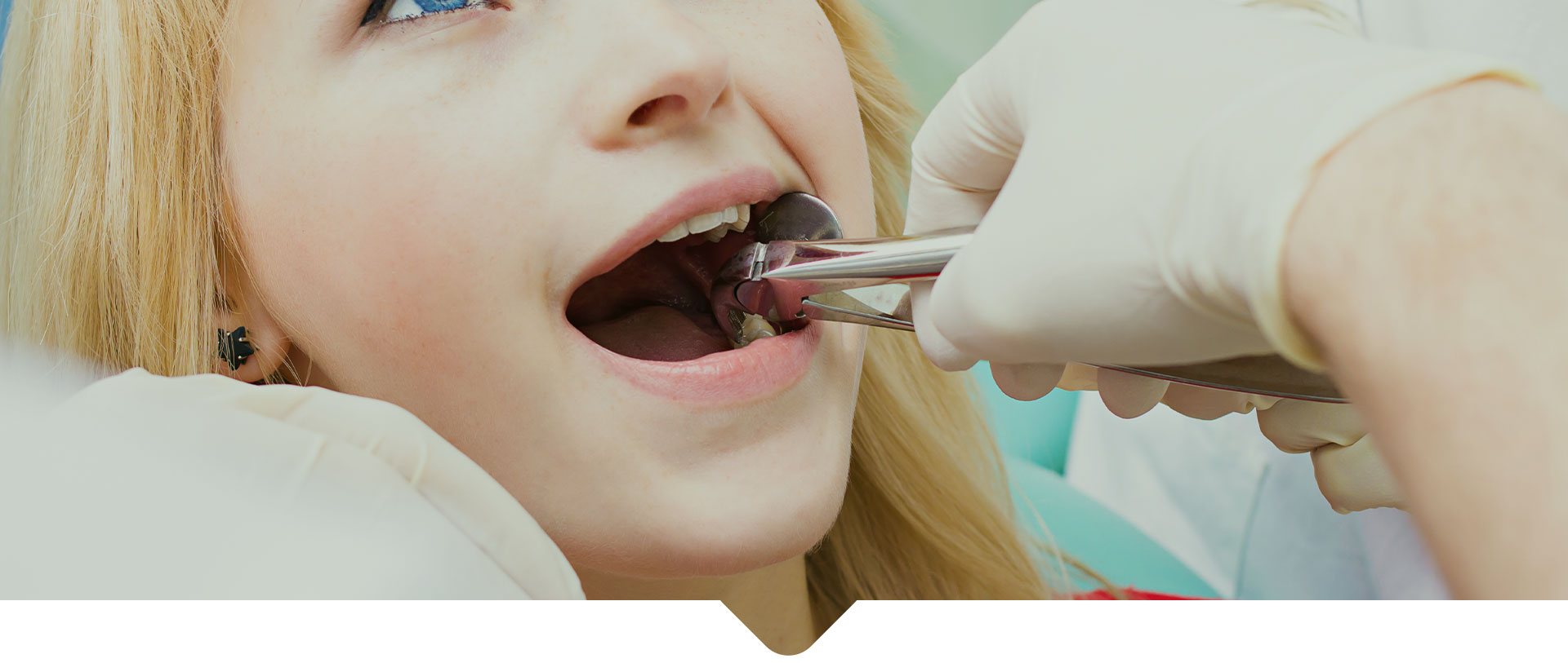 Doctor dentist performing extraction procedure with forceps removing patient tooth