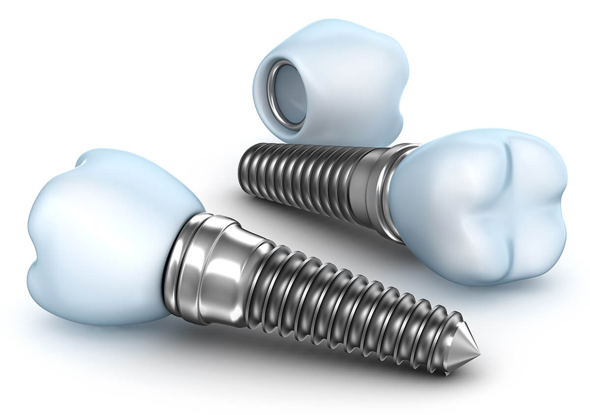 Implants Dentist in San Diego California Area