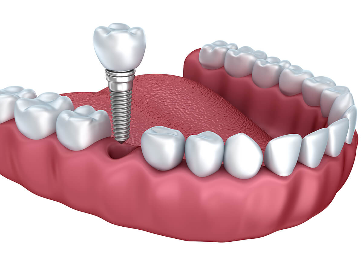 Implant Dentist in San Diego Area