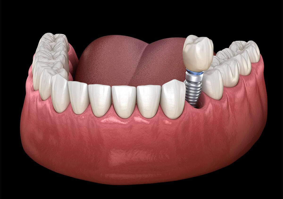 Dental Implant Dentist in San Diego Area
