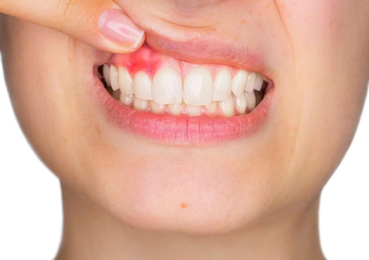 Gum Disease Causes and Treatment San Diego